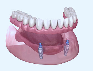 Implant Supported Dentures in Pitman, NJ